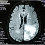 1084px-mri_brain_tumor